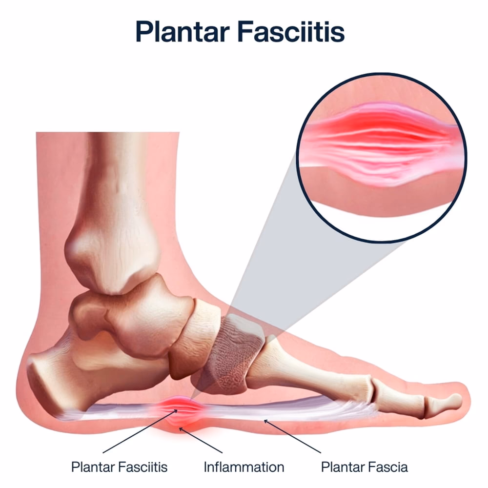 ¿Qué pasa si un zapato se desgasta entre los dedos?