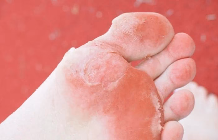 ¿Qué son los hongos en la planta del pie?