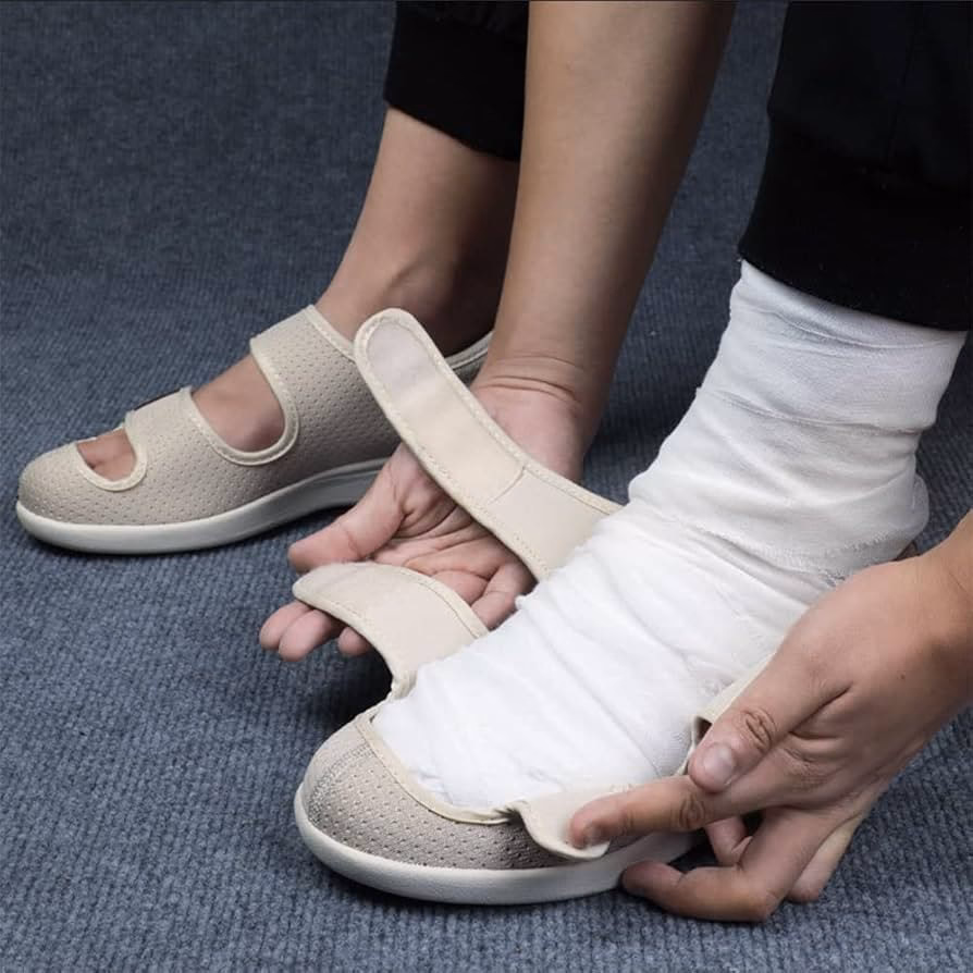 ¿Cuáles son las mejores plantillas para juanetes?