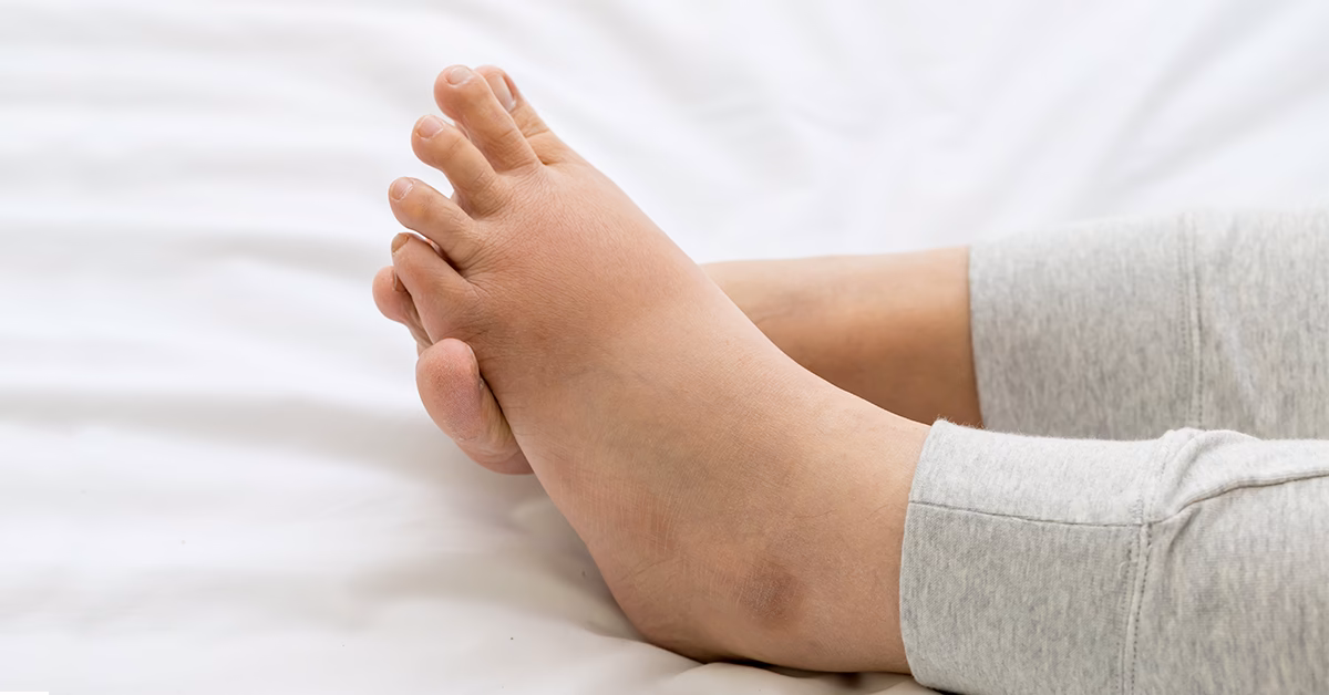 ¿Qué causa la hinchazón de los pies?