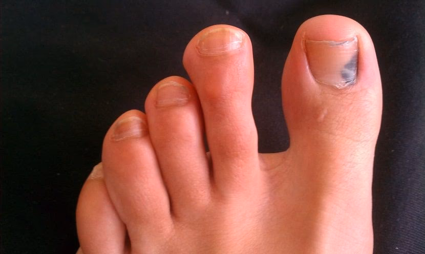 ¿Cómo evitar que aparezcan uñas negras?