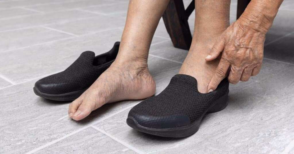 ¿Cuál es el mejor producto para eliminar las varices?